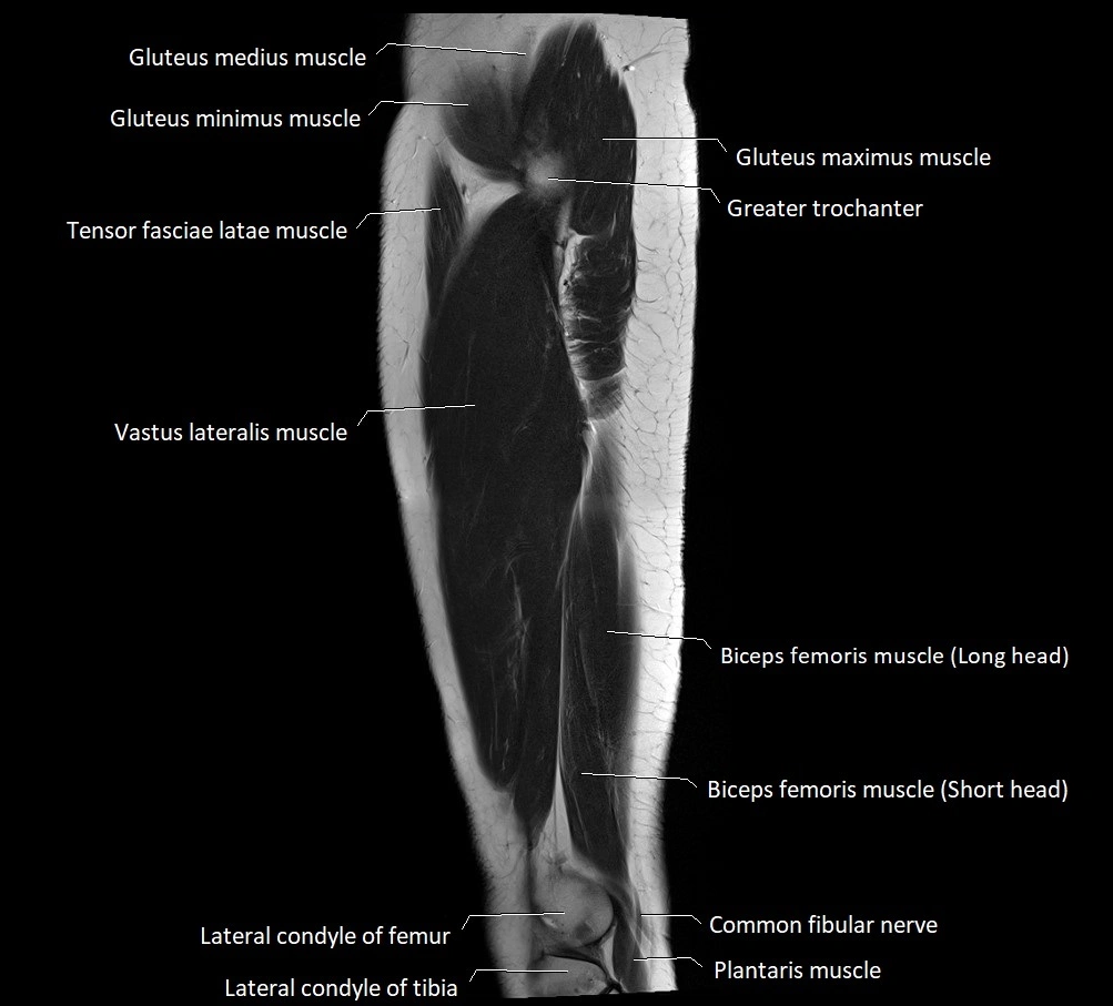 Thigh sagittal cross sectional anatomy MRI 3T image 4.webp